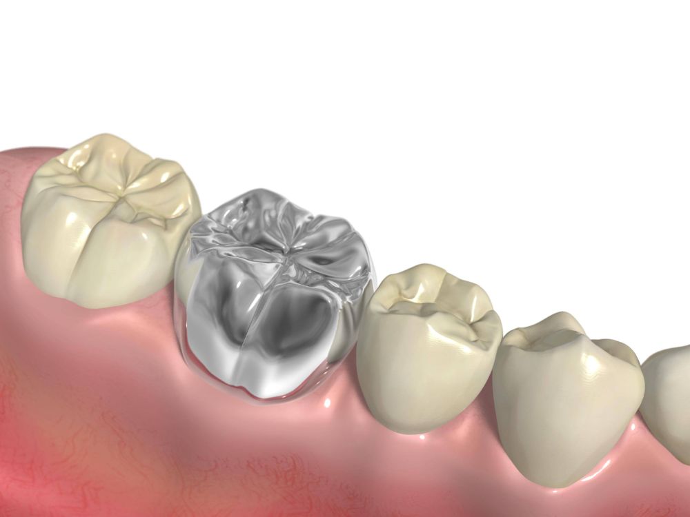 金属アレルギーのリスクを軽減