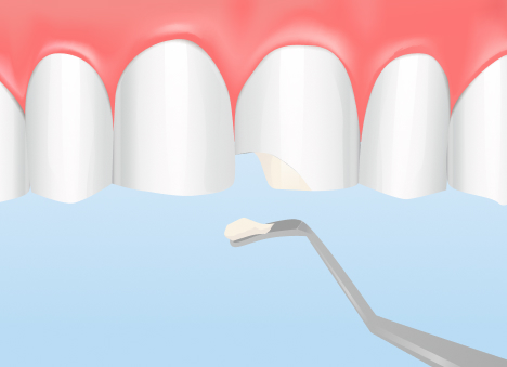 ダイレクトボンディング