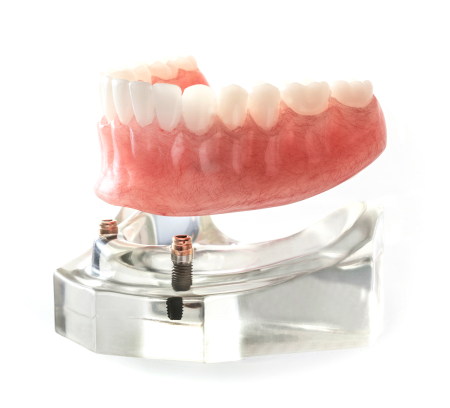 インプラントオーバーデンチャー（自由診療の総入れ歯）