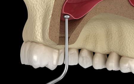 ソケットリフト