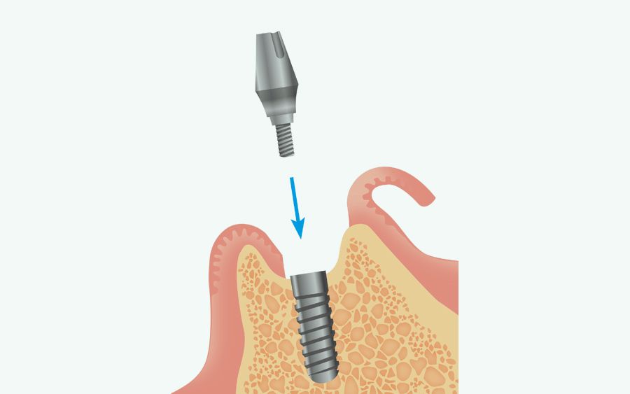 2次手術とアバットメントの装着