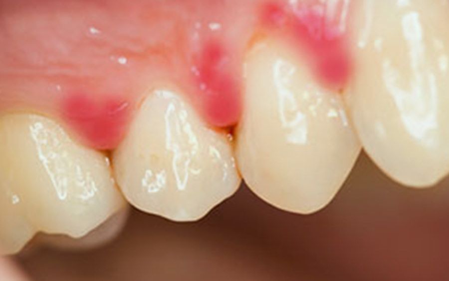 インプラント周囲炎