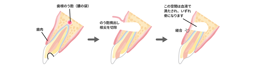 歯根端切除術にも対応