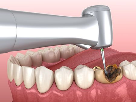 歯髄まで歯を削る