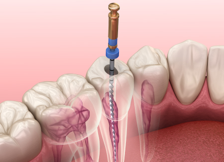 感染した歯髄の除去