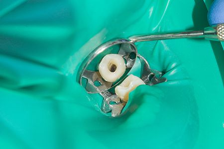 根管の清掃・消毒