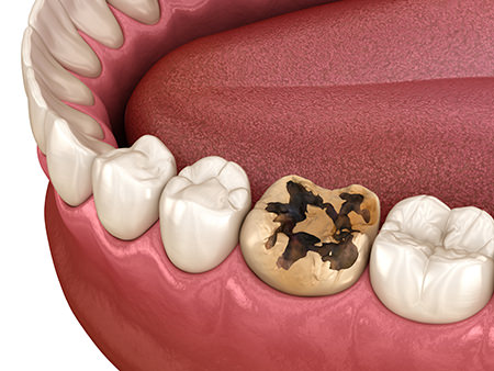 当院では治療の前に必ず、患者さまのむし歯の状況をご説明し幅広い選択肢から治療方法をご提案いたします。このような症状がありましたら、当院までご相談ください。