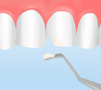 ダイレクトボンディング