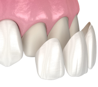 ラミネートべニア