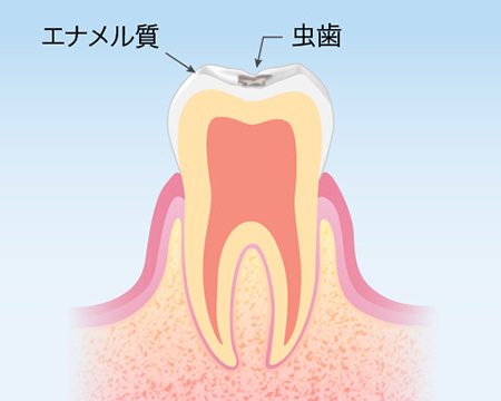 むし歯の原因は？