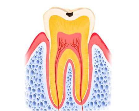 初期むし歯（CO）