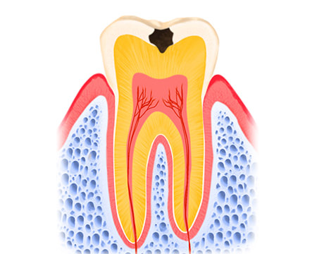 エナメル質のむし歯（C1）