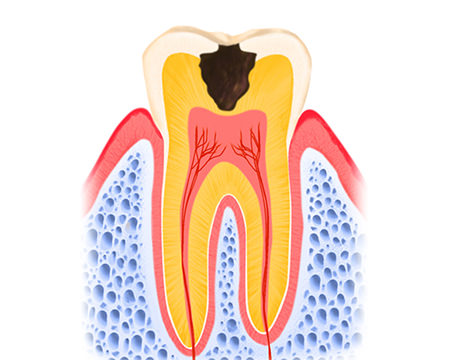 象牙質まで進行したむし歯（C2）
