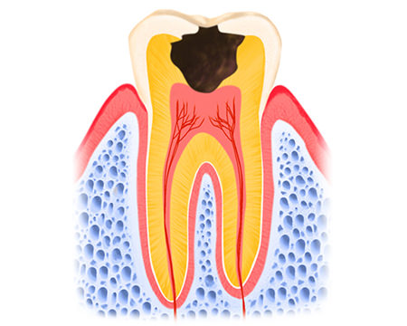 神経まで進行したむし歯（C3） 