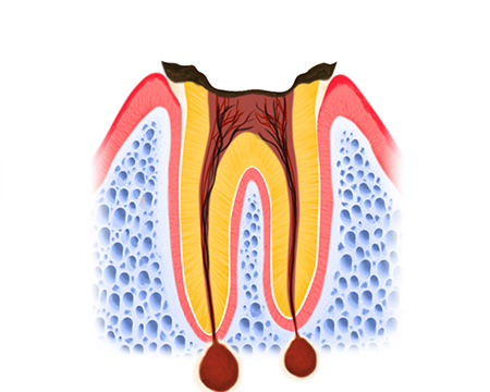 歯根だけ残ったむし歯（C4） 