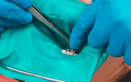 「環境を整える」ラバーダム防湿・歯科治療防湿器具