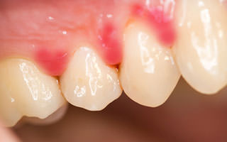 十分な説明がないまま、歯石取りをされたことはありませんか？