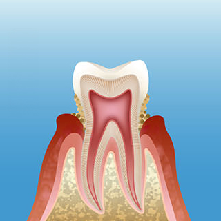 軽度歯周炎